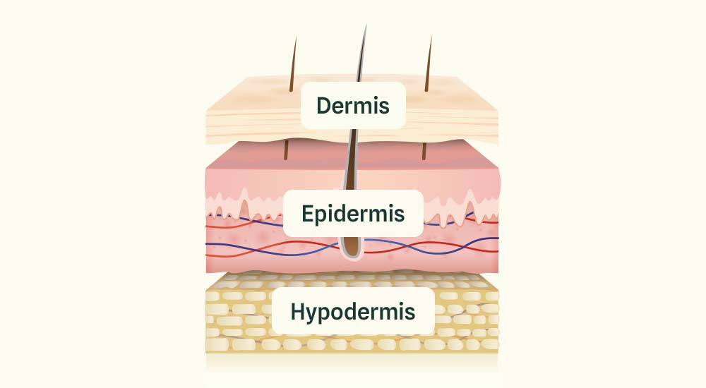 Illustration av de olika hudlagren ovanpå varandra. Överst: dermis. I mitten: epidermis. Underst: hypodermis.